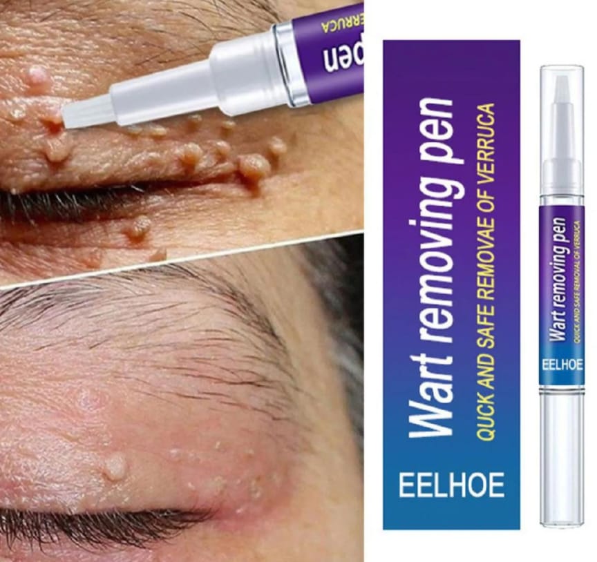 Wart Removal Pen & Wartner Verruca, Removal Of Warts Liquid Pen Woman Skin Care Removing Against Moles Pimple Patch Remove Black Dot