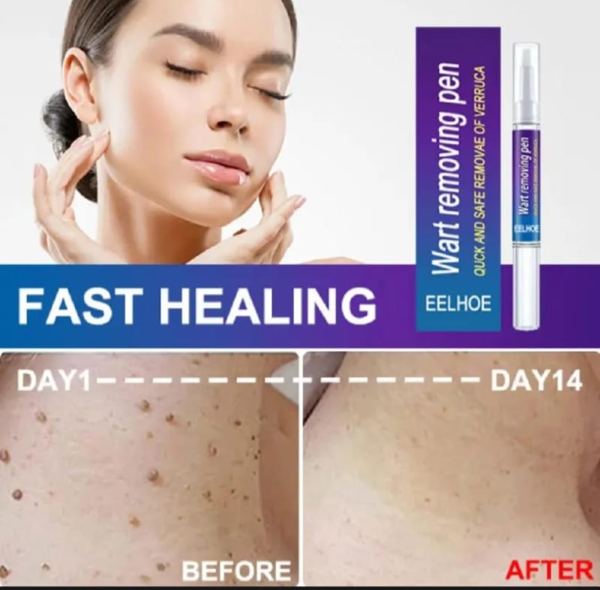 Wart Removal Pen & Wartner Verruca, Removal Of Warts Liquid Pen Woman Skin Care Removing Against Moles Pimple Patch Remove Black Dot
